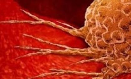 Neonata con un tumore da 800 grammi, salvata con un doppio intervento