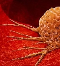 Neonata con un tumore da 800 grammi, salvata con un doppio intervento