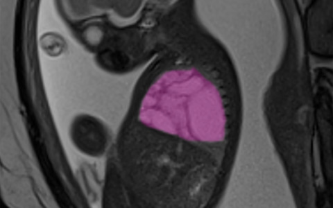 Operato in utero per una cisti grande come un’arancia, sta bene